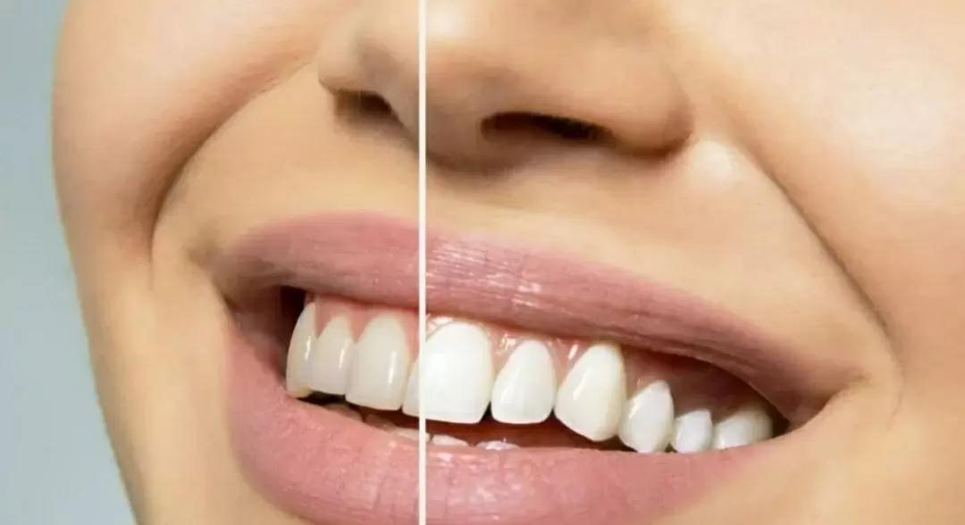 Отбеливание зубов: освежите свою улыбку с помощью профессионального подхода