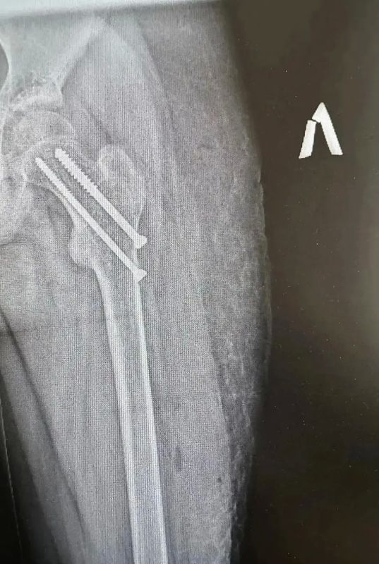 Две ноги с переломами прооперировали 14-летнему «хрустальному мальчику» в Ельце Две ноги с переломами прооперировали 14-летнему «хрустальному мальчику» в Ельце